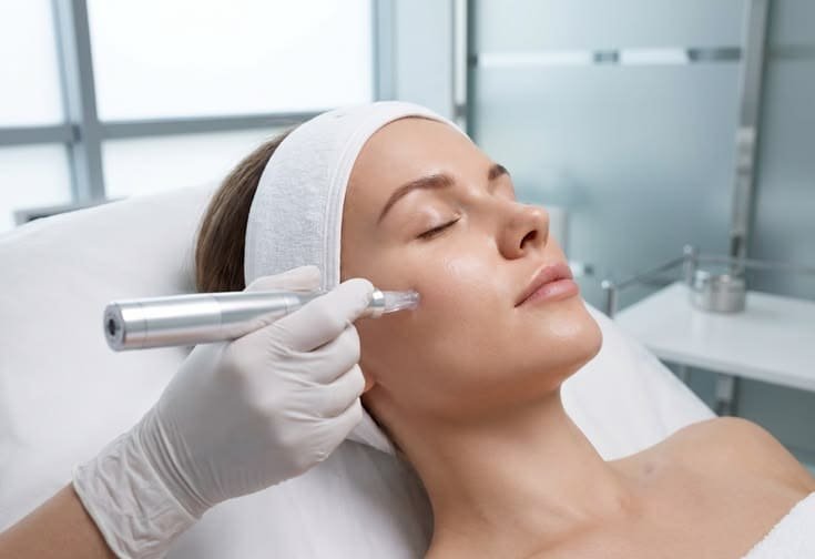 Dermapen con Vitamina C — fotografía proporcionada por Mertherapy