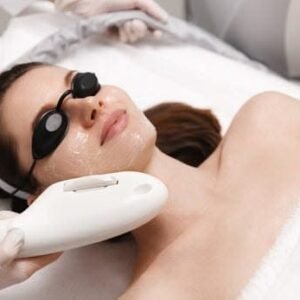 IPL antiacné