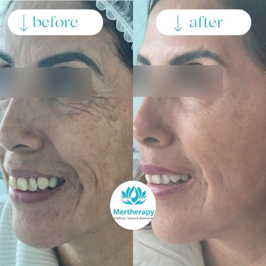 Fotografía de tratamiento con bioestimuladores de colágeno en Mertherapy