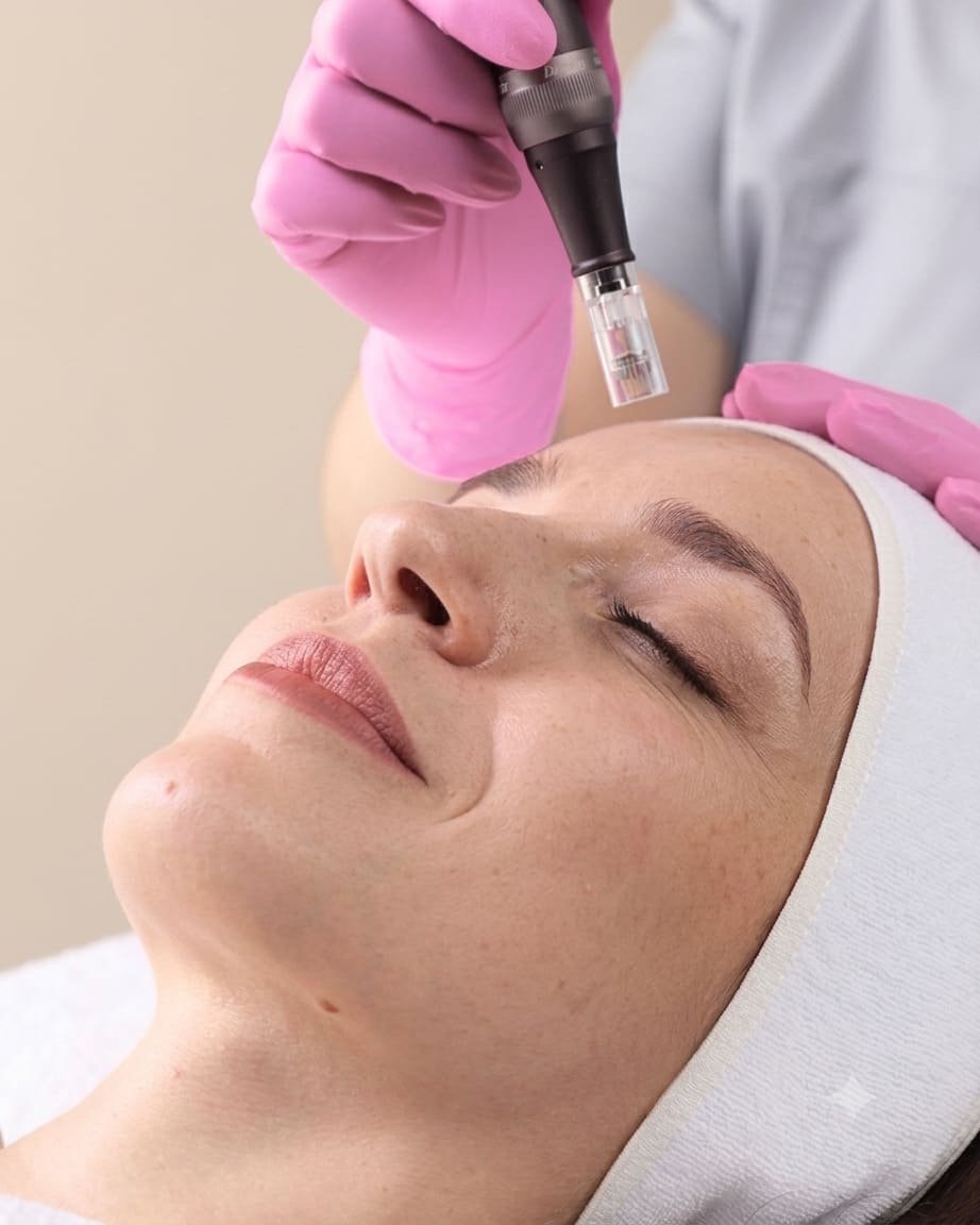 Procedimiento Dermapen con ácido tranexámico