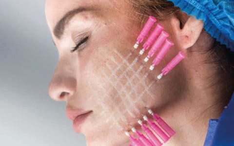 Tratamiento facial con hilos tensores