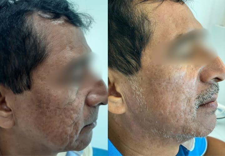 Láser CO₂ Fraccionado — fotografía proporcionada por Mertherapy