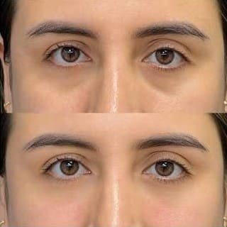 Aplicación de tratamiento con polinucleótidos de ADN de salmón para párpados en el contorno de ojos
